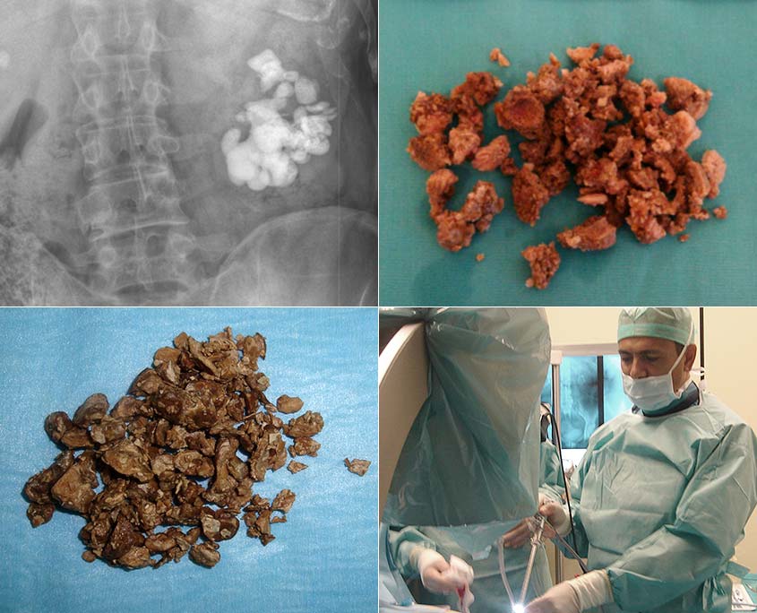 Kidney Stone Surgeon - Percutaneous Kidney Surgery - For which diseases it is used? - Sinan Zeren MD Professor of Urology